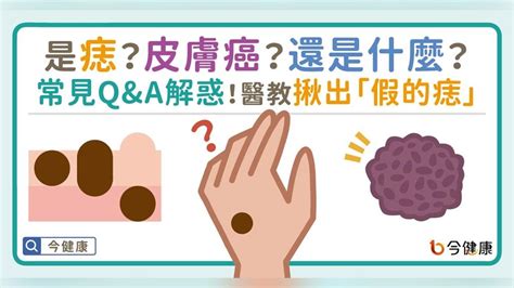 長毛的痣|是痣？皮膚癌？還是什麼？常見Q&A解惑！醫教揪出「。